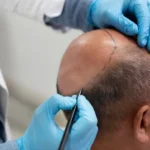 Hair Transplant in India