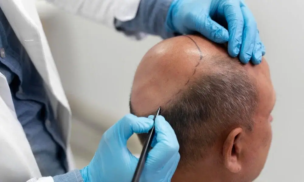 Hair Transplant in India: The 2026 Decision Guide for International Patients